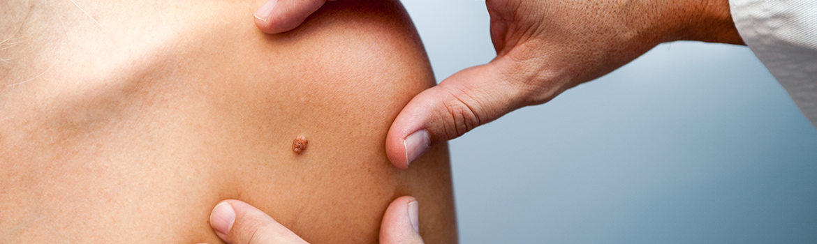 Cómo identificar un cáncer de piel